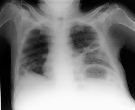 dansiteleri. b RESİM 3: Akciğer grafisinde solda total pnömotoraks. RESİM 4: Tedavinin üçüncü ayında çekilen akciğer grafisinde lezyonlarda tama yakın regresyon.