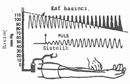 İndirekt yöntemler Dokunma (Palpatory) Yöntemi: Yandaki şekilde bu yöntem gösterilmiştir. Kolu saran kafın basıncı sistolik basıncın üzerine çıkarılır.