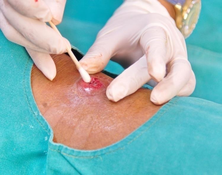 Doku örnekleri Cerrahi işlemler sırasında alınan doku örnekleri hasta için risk ve maliyet.