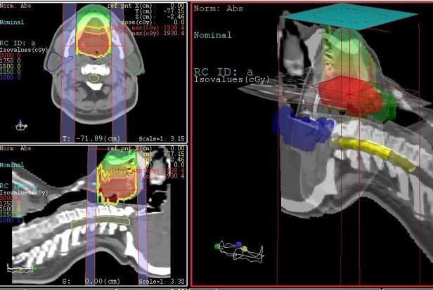 Planlama sisteminde DICOM 3 protokolüyle tomografi cihazından alınan aksiyal kesitler üzerinden sagital ve koronal düzlemlerde rekonstrüksiyon yapılmakta, oluşturulan üç boyutlu anatomik