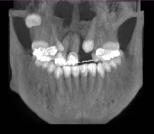 Kemik greftinin avantajları; Maksiller segmentlerin stabilizasyonu Yarığa yakın olan bölgede diş erupsiyonlarını kolaylaştırmak Yarığa yakın olan dişlerdeki kemik desteğini arttırmak