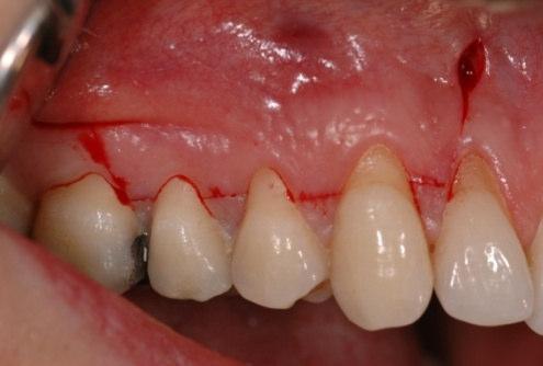 Ensizyon, dişeti çekilmesi olan diş/dişlerde sulkuler olarak devam ettirildi (Resim 3.9). Muko-gingival sınıra kadar tam kalınlıkta mukoperiostal flep kaldırıldı (Resim 3.10).