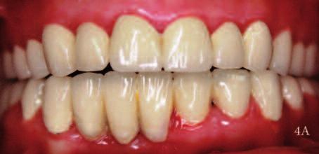 Birinci hafta, üçüncü ve altıncı aylardaki kontrollerinde olguların protezleri, destek dişler ve yumuşak doku ile ilgili herhangi bir komplikasyon olmadığı izlenmiştir (Resim 4A, B).