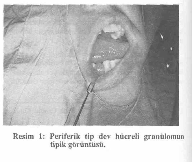 Yirmidokuz dev hücreli granülomalı hastanın 5'inde tümör periferik tipteydi. Bunlardan 3 tanesi sağ alt dental arkta yer alan polipoid, üzeri ülsere lezyonlardı.