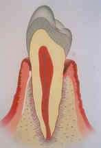 Re-ataşman : Daha önceden cep oluşmamış bölgelerde, travma, cerrahi, diş kırığı yada periapikal bir lezyon sonucu ayrılmış sementin mevcut olan diş kökü bölgelerindeki tamirdir.