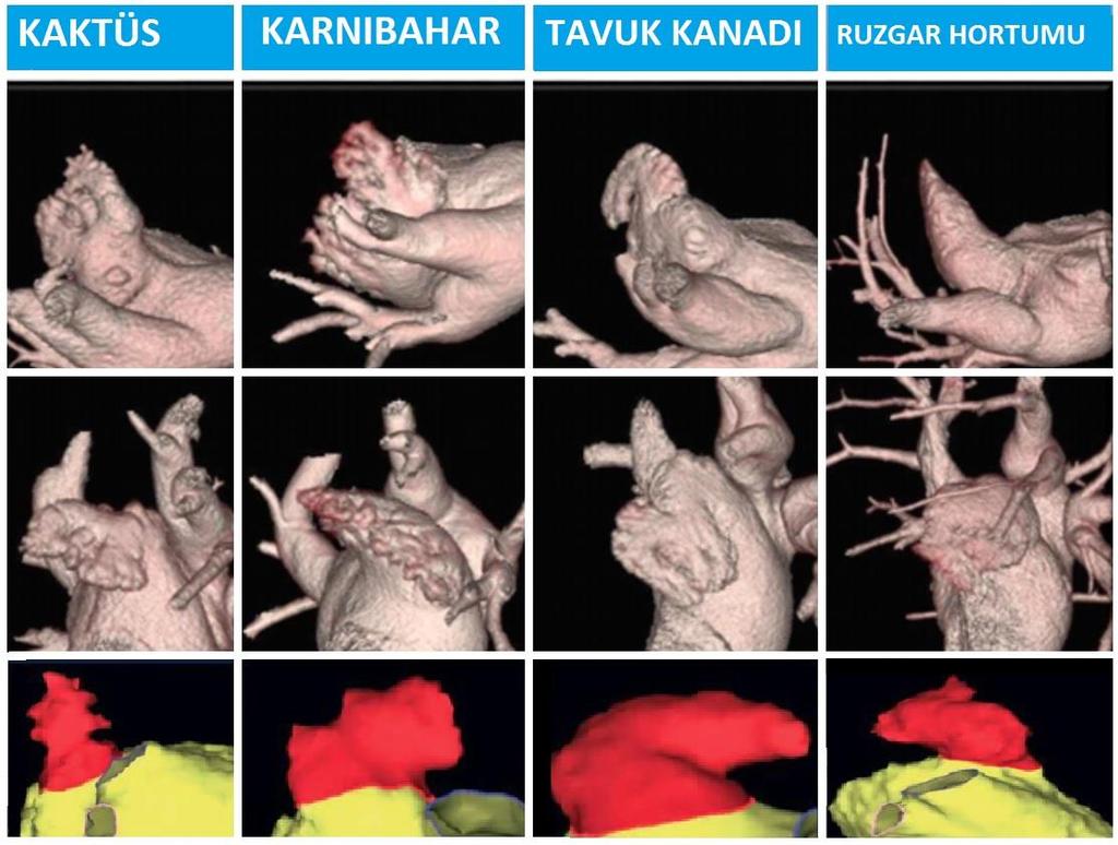 Anatomik Degişkenlik ve İnme İle İlişki Prevalans %11-30 %3-29