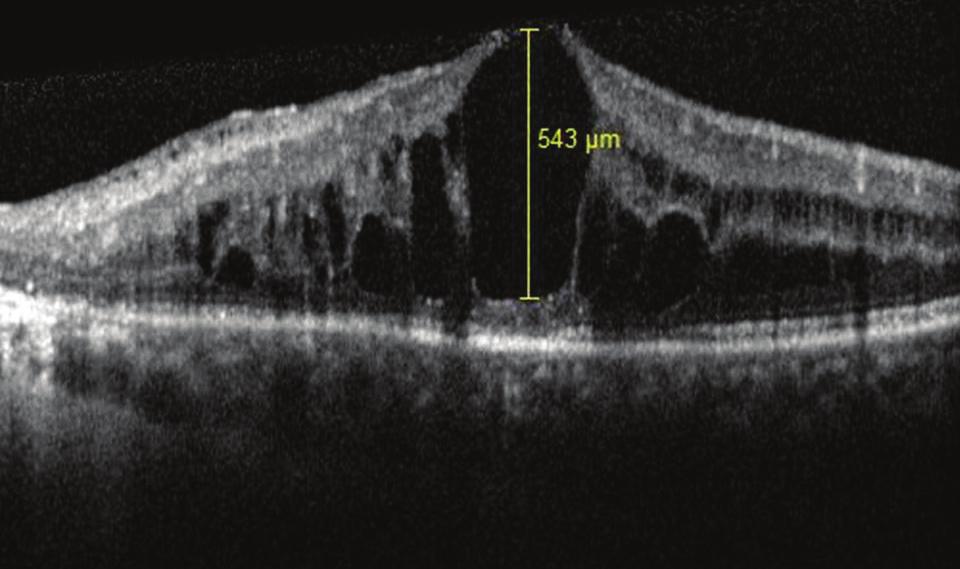 6 sıklıkta izlenir. Erkeklerde, kadınlara göre daha fazla görülmektedir. 4 Retinal ven tıkanıklığında görme kaybının en önemli nedeni maküla ödemidir.