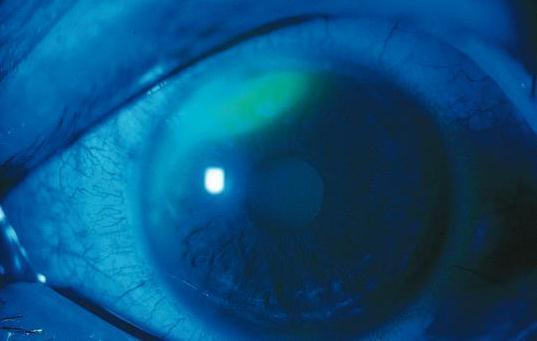 GÖZ TRAVMASI Korneal abrazyonların çoğu kendiliğinden düzeldiği için tedavide amaç ağrıyı azaltmak, enfeksiyonu önlemektir. Gözün kapanması iyileşmeyi etkilemez.