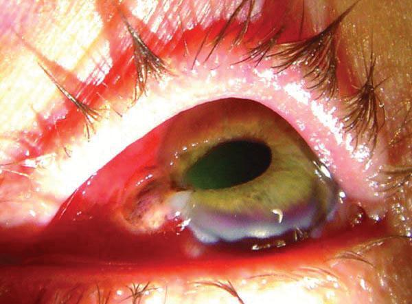 GLOB RÜPTÜRÜ Kolayca gözden kaçabilen ve görmeyi tehdit eden acil bir durumdur. Oküler cerrahi ve daha önceki göz yaralanması rüptür riskini arttırabilir.