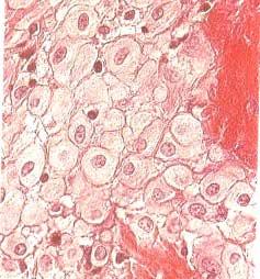 Şekil 2.1.5.2. Desidual hücre kümesinin H.E. fotoğrafı, x300 (Pathology of the Human Placenta, 2006) Progesteron, desidualizasyon sürecinin en güçlü uyarıcısıdır.