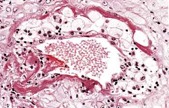 Şekil 2.3.1. Preeklampsili bir hastanın desidual spiral arteriolünde atherosis (Pathology of the Human Placenta, 2006) Marais ve ark.