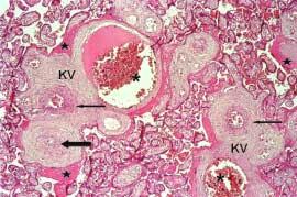 Birinci, ikinci, dördüncü ve beşinci preeklampsi vakalarında santral plasenta örneklerinde kök villuslarda fetal damar duvarlarında kalınlaşmalar ve kısmen damar lümeninde obliterasyonlar(vazospazm)