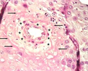 Preeklampsi Vaka 3, Periferik Plasenta Kesiti, Desiduada spiral arteriyol damar duvarında ödem mevcut(yıldız işaretleri), damar