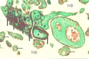 Preeklampsi Vaka 3, Periferik Plasenta Kesiti, fötal kapillerler, trofoblast ve endotel bazal membranı içeren terminal villuslar(ince ok işaretleri), kök villus dalları(kalın ok işaretleri),pas