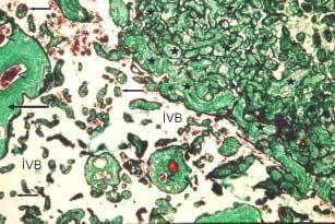 işaretleri), Kök villus yüzeyinde sinsityotrofoblast(ok işareti), x100, Masson un Trikrom Histolojik Boyama Yöntemi Preeklampsi vakalarında, periferik plasenta kesitlerinde, yer yer koryon