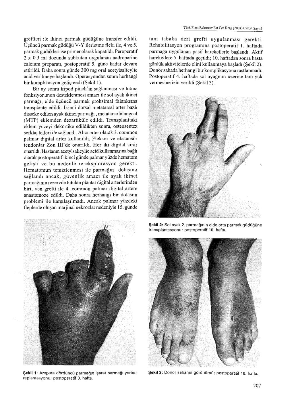 Türk Plast Rekoııstr Est Cer Derg (2001) Cilt:9, Sayı:3 greftleri ile ikinci parmak güdüğüne transfer edildi. Üçüncü parmak güdüğü V-Y ilerletme flebi ile, 4 ve 5.