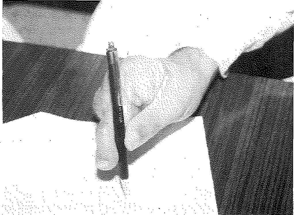 Yazarların makalede belirttiği gibi özürlü kalan elin iyi değerlendirilmesi ve planlanması sonucu yapılan ayaktan ele parmak aktarımları ile daha çok fonksiyon gören bir el yaratılması mümkün