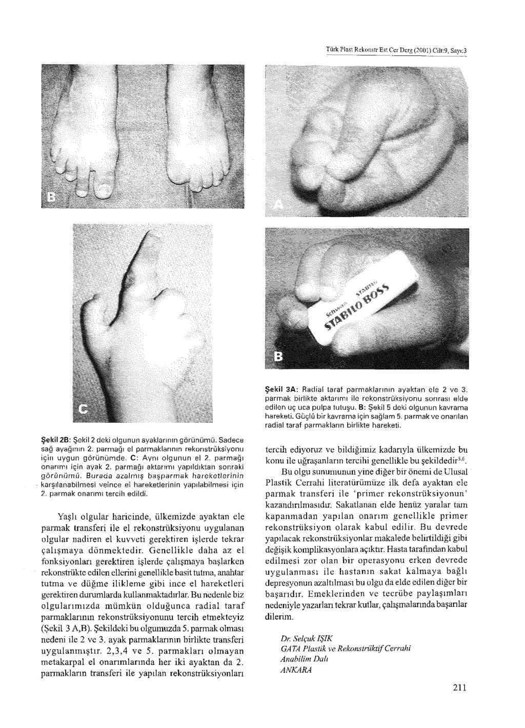 Türk Plast RekoııstrEst CerDcrg (2001) Cilt:9, Sayı:3 Şekil 3A: Radial taraf parmaklarının ayaktan ele 2 ve 3. parmak birlikte aktarımı ile rekonstrüksiyonu sonrası elde edilen uç uca pulpa tutuşu.
