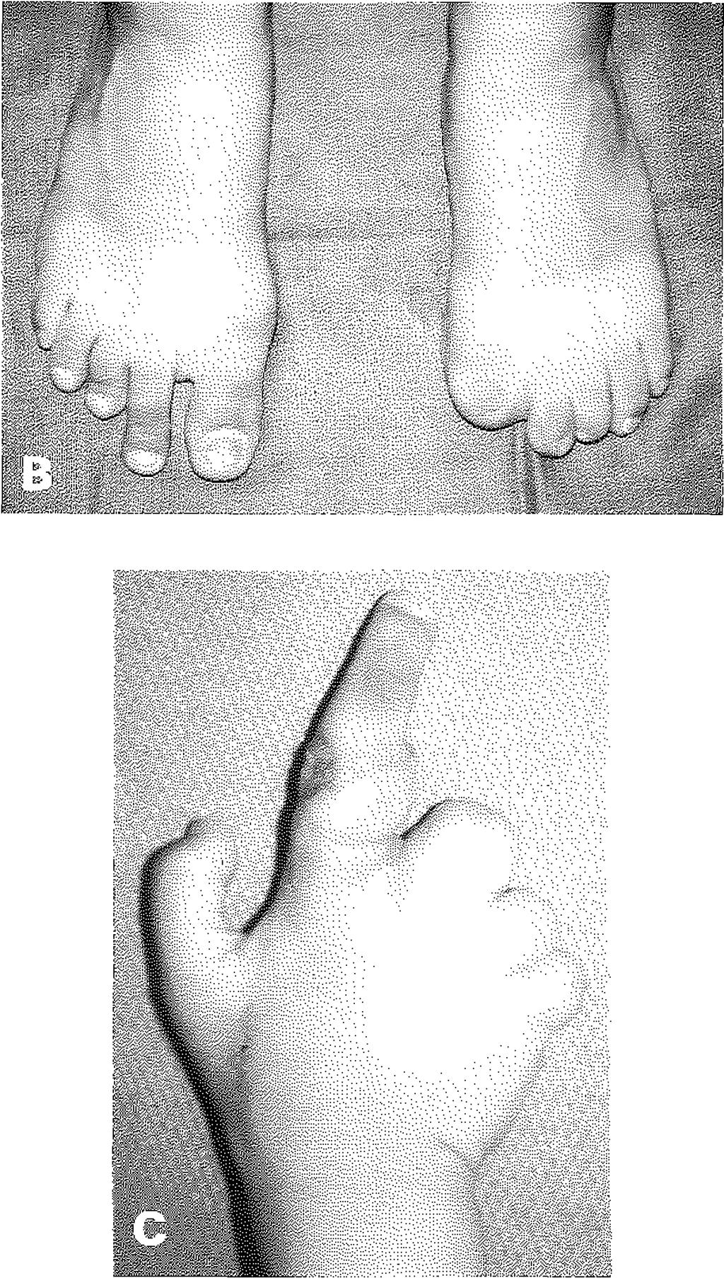 Sadece sağ ayağının 2. parmağı el parmaklarının rekonstrüksîyonu için uygun görünümde. C: Aynı olgunun el 2. parmağı onarırını için ayak 2. parmağı aktarımı yapıldıktan sonraki görünümü.