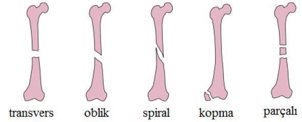 KIRIKLAR VE İLK YARDIM 8 Kırık Çeşitleri Kırık