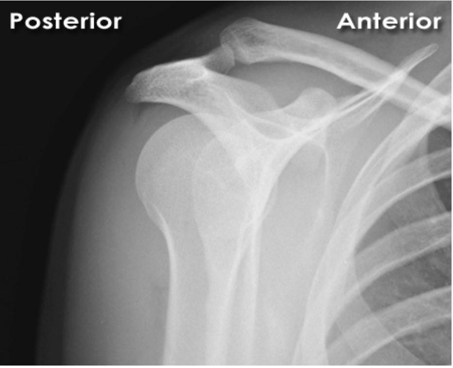 anterior glenohumeral çıkık  grafi