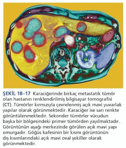 5. Kanser hücreleri metastaz yapar Kanser hücreleri; Orijinal tümör bölgesinden ayrılıp, Kan veya lenf sistemine