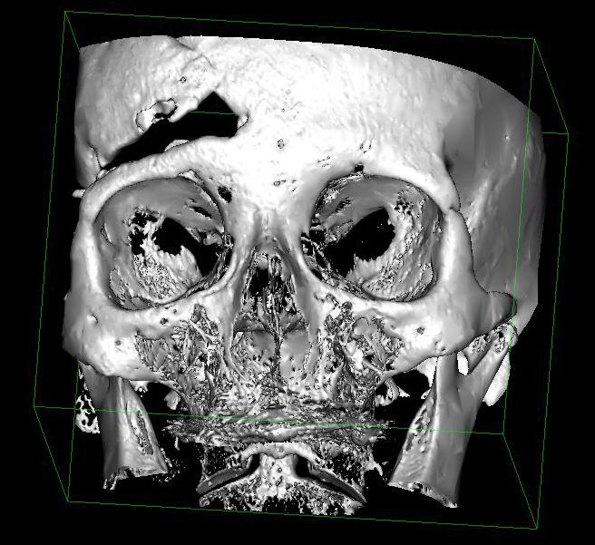 Preoperatif 3 boyutlu Tomografi de sağ frontal sinüste önceki operasyona sekonder kemik defekt.