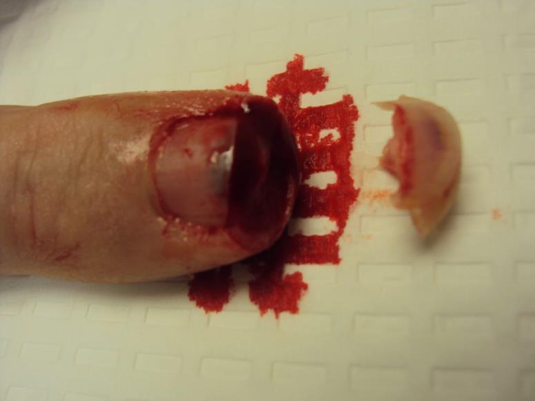 17 Şiddetli Travma (Acute Trauma) Kopmalar (Amputations): En sık parmak kopması şeklinde görülür.