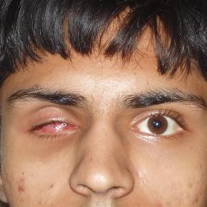19 Şiddetli Travma (Acute Trauma) Göz Kaybı (Eye Loss): Göz kayıplarının çoğu göze metal, tahta veya cam parçası kaçması sonucu meydana