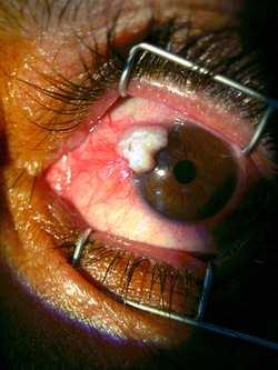 Resim 1. 59 yaşındaki bir olgunun sağ göz nazal limbusuna yerleşmiş skuamoz hücreli tümör. sonrası nüks oldukça sıktır (%5-56).