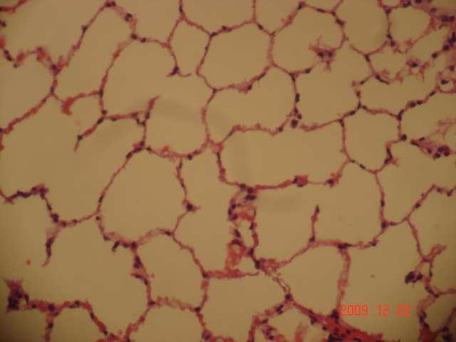 APC grubuna ait hafif derecede kalınlaşmış alveol duvarları ve minimal fibrozise ait görüntüler resim 9 da,