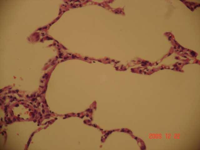 Resim 9: APC grubunda grade 1 fibrozis (minimal fibrozis