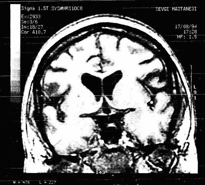 50 Resim 2.1: T1 ağırlıklı MR resmi (koronal düzlemde beyin kesiti). TR / TE: 500 / 15 msec.