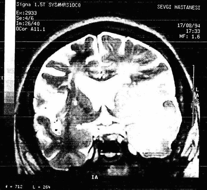 56 Resim 2. 3: T2 ağırlıklı MR resmi (Koronal düzlemde elde olunmuş beyin kesiti). TR / TE: 3500 / 100 msec zemin paraziti olmasına rağmen sinyal kuvvetli iken bu fark edilmez (ya da önemsenmez).