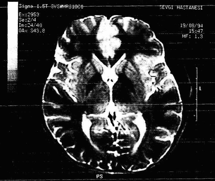 17 Resim 2.5: T2 ağırlıklı MR resmi (aksiyal düzlemde beyin kesiti). TR / TE: 3500 / 100mSec.