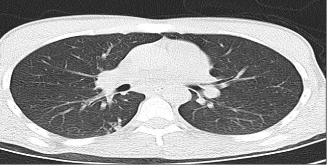 Görüntüleme Antitüberküloz tedavi başlanmış olan hastaya akciğer tüberkülozu şüphesiyle toraks tomografisi çekildi.