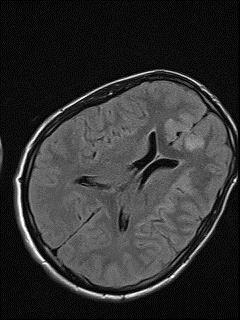 Beyin MR Bilateral frontal loblarda yeni oluşan, difüzyon