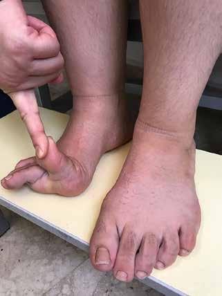 Çocuklarda ayak muayenesi 387 Şekil 6. Esnek düztabanlıkta sağ ayakta birinci parmağın elevasyonu ile uzunlamasına ayak arkının oluşması (Jack testi).