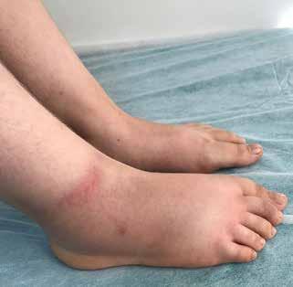 388 TOTBİD Dergisi SONUÇ Çocuklarda ayak yakınmaları hastaneye sık başvurma nedenidir.