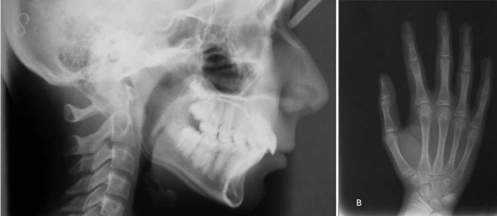 Dik Yönü Artm fl S n f II Maloklüzyonlu Vakaya Cerrahi Olmayan Ortodontik Tedavi Yaklafl m A Nonsurgical Approach to Treatment of High-Angle Class II Malocclusion flim oldu unu göstermifltir (Resim