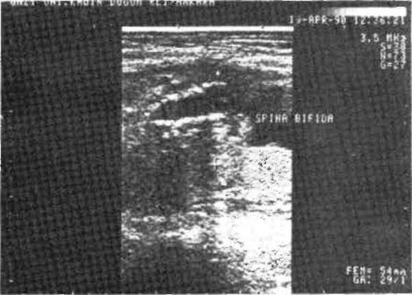Şekil 3'de belirtilen aynı vakanın longilüdiııal kesitte "Spina Bifida" görüntüsü Şekil 5.