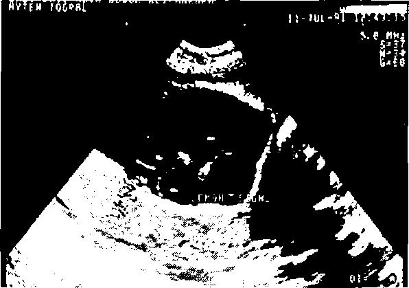 Rutin ultrasonografi kullanımı ile gestasyon yaşının saptanması sonucu postterm indüksiyon hızının azaldığını gösteren klinik çalışmalar yanında, arada fark olmadığını bildiren çalışmalar vardır