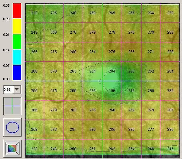 OCT / SLO Retinal Kalınlık ( Grid ) Her