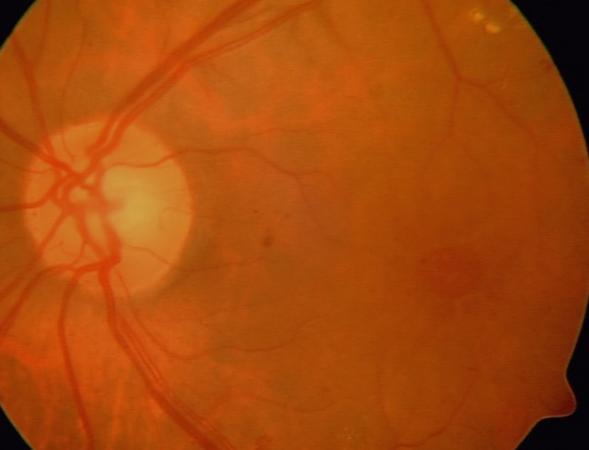 hassas değiller FFA: yaygınlık, sızıntının kaynağı, retinal kapiller non-perfüzyon Geniş