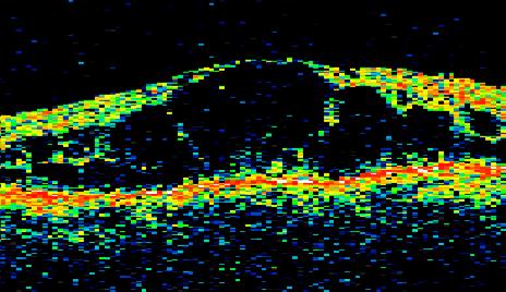 kalınlık, retinal ödem tipleri, kistler, subretinal sıvı, vitreoretinal arakesit * OCT