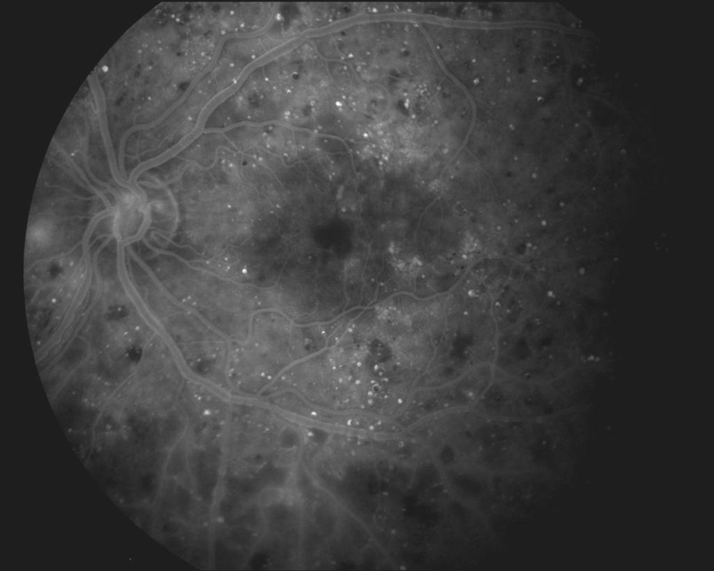 DMÖ - tanı Flöresein Anjiografi Kan-retina bariyeri bütünlüğü Vasküler sızıntı paterni Vasküler