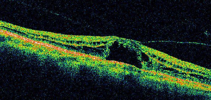 DMÖ de, fovea merkezine