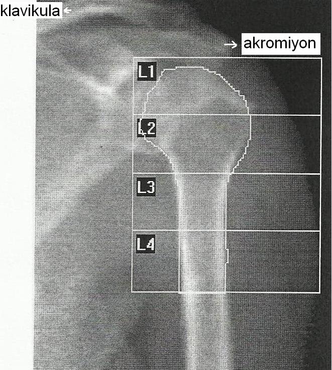 3.2.1. Humerus proksimali vertikal eksen ölçümleri Çekim yapılırken humerus lazer işaretleyici vertikal eksene paralel olacak şekilde pozisyon verildi.