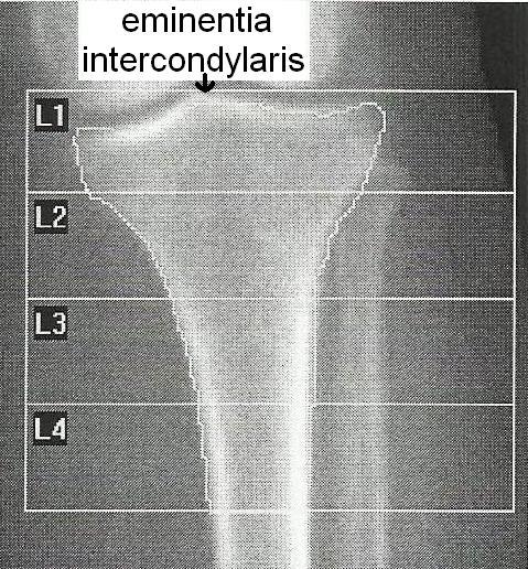 3.2.4. Tibia proksimali ölçümleri Çekim yapılırken hasta sırt üstü yatarken diz eklem bölgesi palpe edildikten sonra sol tibia 180 derece düz eksende olacak şekilde çekimler yapıldı.