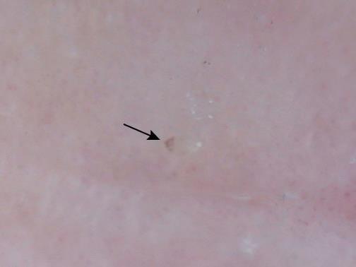 Dermoskopik muayenede karakteristik bulgu, bir yuva ( delta kanat işareti) içindeki akar başını temsil eden